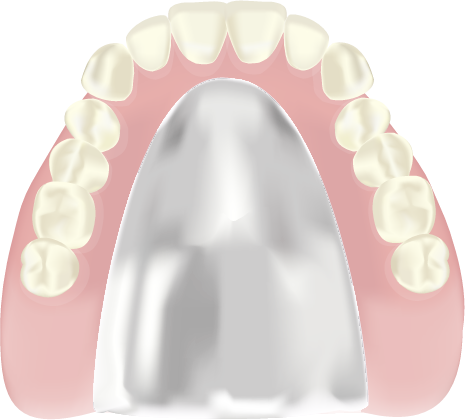 合金床義歯